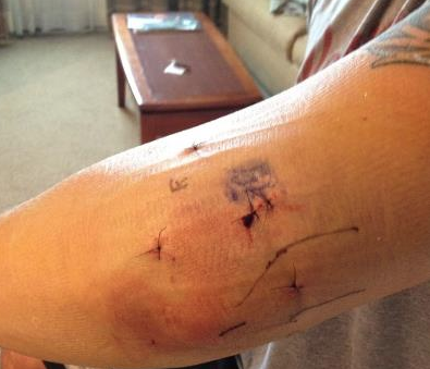 Chris_Weidman_Elbow_post-surgery.png